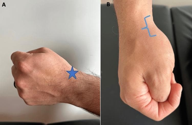 Two clinical photographs demonstrate the positioning for the Finkelstein test, a physical examination maneuver used to diagnose De Quervain tenosynovitis. Image A (lateral view) shows a patient's hand formed into a fist with the thumb tucked inside the fingers. A blue star indicates the first dorsal compartment of the wrist, where patients with the condition typically experience sharp pain during ulnar deviation. Image B (superior view) shows the same fist position from above, with a blue bracket highlighting the anatomic snuffbox region on the radial aspect of the wrist. This visual guide illustrates how clinicians can instruct patients to localize pain or palpate the radial styloid and associated tendons (abductor pollicis longus and extensor pollicis brevis). The maneuver is a key orthopedic assessment tool for evaluating stenosing tenosynovitis of the first extensor compartment.