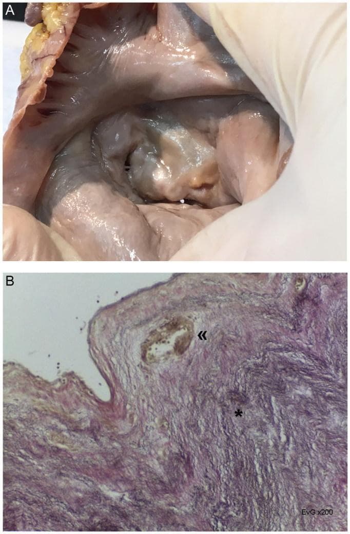 This composite educational material demonstrates macroscopic and microscopic features of Rheumatic (post-inflammatory) Valvulopathy. Image A is a clinical photograph of a human mitral valve specimen from an autopsy, viewed from the atrial aspect. It illustrates significant valvular stenosis characterized by thickening of the leaflets and fusion of the commissures, resulting in the classic 'fish mouth' or 'smiling face' slit-like deformity. Image B is a histopathological micrograph of the valve leaflet at x200 magnification, stained with Elastic van Gieson (EvG). The microscopic section reveals extensive fibroelastosis, indicated by the dense network of elastic and collagen fibers (marked by an asterisk), and the presence of neovascularization featuring thick-walled vessels at the distal part of the leaflet (marked by double chevrons). These findings are diagnostic markers for chronic rheumatic heart disease, demonstrating the structural remodeling that leads to valvular dysfunction and heart failure.