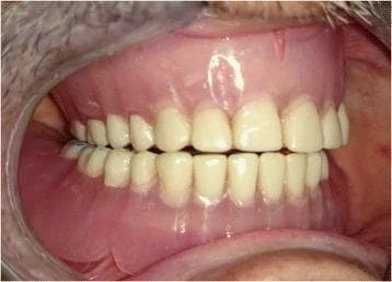 This intraoral clinical photograph showcases a set of complete maxillary and mandibular dentures in a state of bilateral balanced occlusion. The visual demonstrates the prosthetic alignment of off-white artificial teeth, which mimic natural tooth morphology including incisors, canines, and premolars. The teeth are set into a pink acrylic denture base designed to simulate natural gingival tissue. Key visual features include the simultaneous, even contact between the upper and lower arches across both the anterior and posterior segments. This occlusal scheme is a fundamental concept in prosthetic dentistry, intended to provide stability to the denture bases during functional movements and parafunctional habits. The photograph highlights the relationship between the prosthetic teeth and the supporting soft tissue, emphasizing the aesthetic and functional integration of the dental prostheses within the oral cavity.