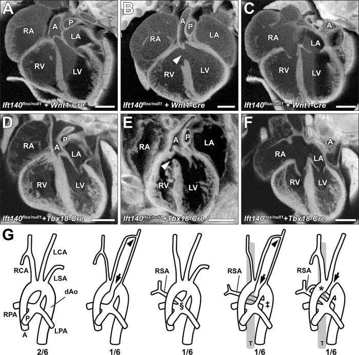This educational image presents a series of cardiac diagnostic images and anatomical diagrams detailing congenital heart defects. Panels A–F display episcopic confocal microscopy (ECM) cross-sections of experimental hearts. The four chambers—right atrium (RA), left atrium (LA), right ventricle (RV), and left ventricle (LV)—are labeled alongside the aorta (A) and pulmonary trunk (P). Panels A, C, D, and F show normal cardiac looping and septal anatomy, while panels B and E highlight perimembranous ventricular septal defects (VSDs) indicated by white arrowheads. Panel G consists of five comparative diagrams of the aortic arch and great vessels. The first diagram illustrates normal anatomy including the right and left carotid arteries (RCA/LCA) and subclavian arteries (RSA/LSA). Subsequent diagrams depict various great artery patterning defects: an interrupted aorta (arrows), hypoplastic collateral vessels (arrowheads), and anomalous origins of the right subclavian artery (RSA). These anomalies include the RSA arising from the pulmonary trunk (§), as a retrotracheal vascular sling from the descending aorta (‡), or as a vascular ring with dual attachments (*). This content demonstrates complex cardiovascular malformations associated with ciliary gene mutations.