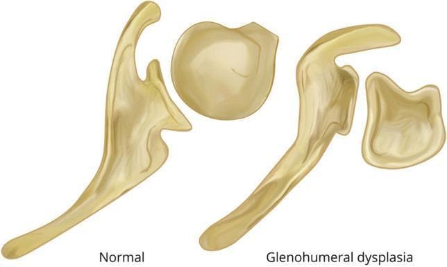 Anatomical comparison diagram of the glenohumeral joint in an axial view, illustrating the morphological differences between a normal shoulder and one with glenohumeral dysplasia secondary to brachial plexus birth injury (BPBI). The left side of the diagram depicts a 'Normal' joint, showing a spherical, well-contoured humeral head centrally seated within a single concave glenoid fossa. The right side, labeled 'Glenohumeral dysplasia,' demonstrates progressive pathological changes: the glenoid fossa is flattened and bi-concave, featuring a distinctive false posterior-inferior facet (pseudo-glenoid). The corresponding humeral head is shown as flattened and retroverted, articulating abnormally with the posterior aspect of the dysplastic glenoid. This illustration serves to teach the secondary skeletal remodeling and posterior subluxation that occurs when muscular imbalance (internal rotation contracture) persists in developing pediatric shoulders after nerve injury. It is a key educational resource for orthopedic surgery and physical medicine and rehabilitation specializing in neonatal brachial plexus palsy.