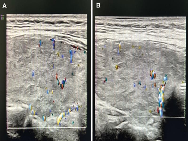 This diagnostic comparison contains two color Doppler ultrasound images (A and B) of the thyroid gland, illustrating the progression of thyroiditis or hyperthyroidism. Image A displays the thyroid parenchyma during the initial presentation, characterized by heterogeneous, coarse echogenicity with a mixture of hyperechoic and hypoechoic textures. A significant increase in vascularity is evident through numerous red and blue Doppler signals distributed throughout the gland, representing hyperdynamic blood flow. Image B shows the same anatomical region at a one-month follow-up. While the parenchyma remains somewhat heterogeneous, there is a marked interval reduction in the density and intensity of the color Doppler signals, indicating decreased thyroid vascularity and clinical improvement. This visual comparison serves to demonstrate the sonographic hallmarks of hyperthyroid states, such as Graves' disease or the thyrotoxic phase of thyroiditis, and the subsequent resolution of hypervascularity following treatment.