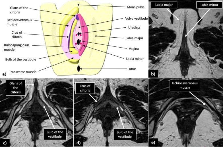 An educational composite featuring a schematic diagram and magnetic resonance imaging (MRI) scans detailing normal female vulvar anatomy. Panel (a) is a color-coded anatomical illustration labeling the mons pubis, labia majora and minora, vulva vestibule, urethra, vagina, clitoris (glans and crus), bulbospongiosus and ischiocavernosus muscles, bulb of the vestibule, and anus. Panels (b) through (e) provide corresponding axial T2-weighted imaging (T2WI) sequences. These radiological images demonstrate the intermediate signal intensity of the labia majora (lateral) and labia minora (medial). Key landmarks visualized in the MRI series include the glans of the clitoris anteriorly, the posterior-medial crus of the clitoris, the bulb of the vestibule, and the ischiocavernosus muscle. The images highlight the high-contrast resolution of MRI for depicting perineal soft tissues, which is essential for the clinical staging of vulvar malignancies. The content is suitable for medical education on pelvic anatomy and radiological interpretation.
