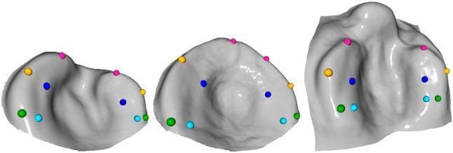 Anatomical diagram and 3D mesh model comparison of different cleft lip and palate (CLP) types, used in orthodontic and surgical planning. The image displays three distinct computer-aided design (CAD) templates. Left: Unilateral cleft lip and palate (UCLP) showing an asymmetrical alveolar ridge with a unilateral indentation. Center: Isolated cleft palate showing a more symmetrical, rounded arch with a central depression. Right: Bilateral cleft lip and palate (BCLP) demonstrating a significant bilateral cleft through the alveolar ridge and a prominent premaxilla. Each mesh is annotated with a standardized set of ten colored landmarks (green, cyan, blue, yellow, and pink spheres) strategically placed to map the surface morphology. The landmarks are concentrated along the alveolar ridges and cleft margins to guide the automated registration of presurgical orthopedic plates. These templates represent the average palatal morphology for each cleft type, serving as educational models for clinical classification and surgical workflow automation in pediatric maxillofacial care.