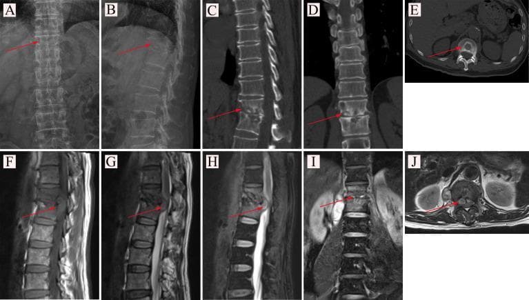 This composite figure presents a multi-modal imaging evaluation of spinal tuberculosis (Pott's disease) in the lower thoracic and upper lumbar spine. (A-B) X-ray radiography in PA and lateral views showing disc space narrowing and endplate irregularities. (C-E) CT images in sagittal, coronal, and axial planes provide high-resolution visualization of bony destruction, vertebral body erosion, and sequestration. Red arrows highlight the focal bone loss. (F-J) MRI sequences offer superior soft-tissue characterization. (F) T1-weighted sagittal view shows low signal intensity in affected vertebrae. (G) T2-weighted sagittal and (H) T2-weighted fat-suppressed (lipid compression) images demonstrate hyperintense signals consistent with inflammatory edema and a prevertebral/paravertebral abscess (red arrows). (I-J) Coronal and axial MRI slices further delineate the extent of the abscess and its relationship to the spinal canal and paraspinal muscles. The collection serves as an educational comparison of imaging modalities (X-ray, CT, MRI) in detecting infectious spondylodiscitis and associated complications like abscess formation.