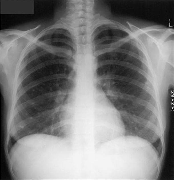 This diagnostic image is a posteroanterior (PA) chest radiograph of an adult, demonstrating multiple small, high-density calcific micronodules. These nodules, measuring approximately 1–3 mm in diameter, are diffusely and randomly distributed throughout both lung fields (bilateral involvement). The nodules exhibit a punctate morphology, characteristic of dystrophic calcification. In this clinical context, these findings represent late sequelae of healed varicella (chickenpox) pneumonia. The mediastinal contour is normal, with no evidence of hilar or mediastinal lymphadenopathy, which helps distinguish this from other granulomatous diseases like histoplasmosis or tuberculosis. The heart size is within normal limits, the pleura appears clear with no effusions, and the visualized bony structures of the thorax, including the ribs and clavicles, are intact. This image serves as a classic educational example of diffuse miliary-pattern calcification resulting from a prior viral pulmonary infection.
