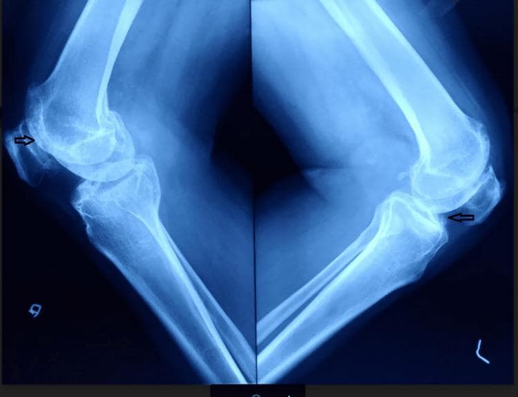 This diagnostic image is a lateral-view plain radiograph of both knee joints showing advanced degenerative changes consistent with Kellgren-Lawrence grade IV osteoarthritis. The imaging demonstrates significant joint space narrowing in the tibiofemoral compartments and evidence of patellofemoral osteoarthritis. Key radiological features include subchondral sclerosis, which appears as increased bone density at the joint margins, and prominent osteophyte formation. Black arrows specifically highlight osteophytes at the superior and inferior poles of the patella and the anterior tibial margins. There is visible narrowing of the patellofemoral joint space. While lateral views typically focus on sagittal alignment, the severe degeneration shown is associated with clinical varus deformity as noted in the patient's history. These findings are representative of end-stage joint disease, which in this clinical context was secondary to ochronotic arthropathy, and indicate the need for total knee arthroplasty (TKA).