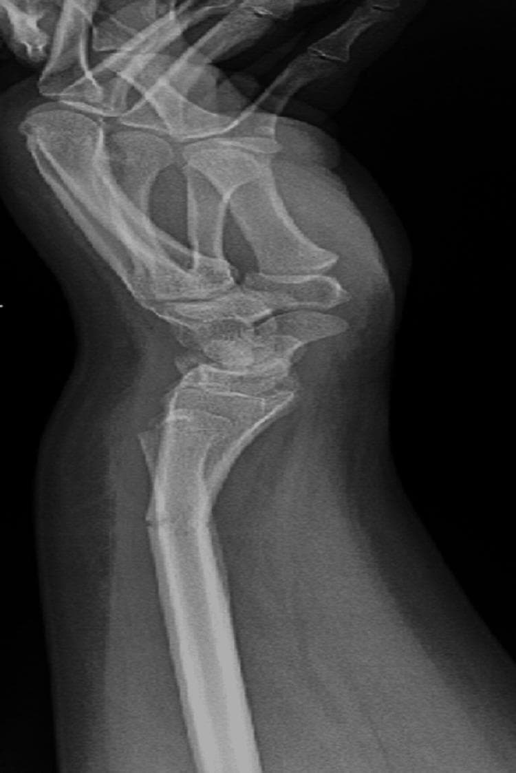A lateral view X-ray of the wrist and distal forearm demonstrating a Galeazzi-equivalent fracture pattern in a pediatric patient. The radiograph reveals two distinct fractures: a transverse fracture in the distal third of the radial shaft with approximately 21 degrees of dorsal apex angulation, and a concomitant fracture of the distal ulna. The ulnar injury is characterized as a Salter-Harris type II physeal fracture involving the distal ulnar epiphysis, showing approximately 2.5 mm of minimal volar displacement. The anatomical alignment between the radius and ulna is disrupted at the level of the fractures, representing a pediatric variant of the Galeazzi injury where a distal ulnar physeal fracture occurs instead of a distal radioulnar joint (DRUJ) dislocation. Pronounced soft tissue swelling is visible around the wrist and distal forearm. This diagnostic image is intended for educational purposes in orthopedics and trauma radiology, focusing on pediatric fracture classification and the management of forearm shaft injuries involving the growth plate.