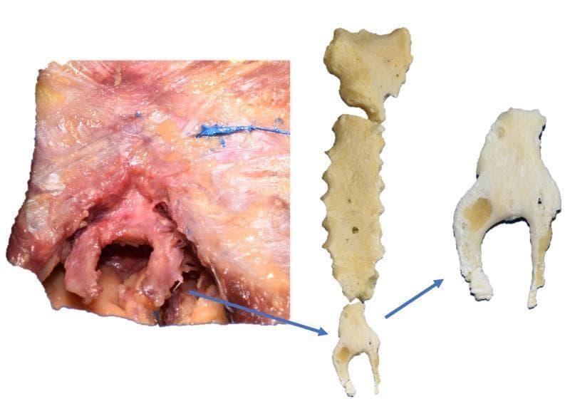 This composite clinical photograph and anatomical display demonstrate an anatomical variation of the sternum: a bifurcated xiphoid process identified during cadaveric dissection. The left panel shows a gross anatomical dissection of the lower thoracic wall, revealing the xiphoid process embedded within muscle fibers and connective tissue. The inferior portion of the xiphoid clearly splits into two distinct, symmetric prongs. The middle and right panels display the isolated, cleaned osseous structures, including the manubrium, sternal body, and the variant xiphoid process. The isolated specimen shows that while the superior half of the xiphoid is unified and articulates with the sternal body, the inferior half is completely bifurcated into two separate bony branches. These branches exhibit roughly equal length and thickness. This variation is clinically significant for surgeons and clinicians performing procedures in the epigastric region or placing chest tubes, as it may impact surface anatomy landmarks or be mistaken for a fracture on diagnostic imaging.