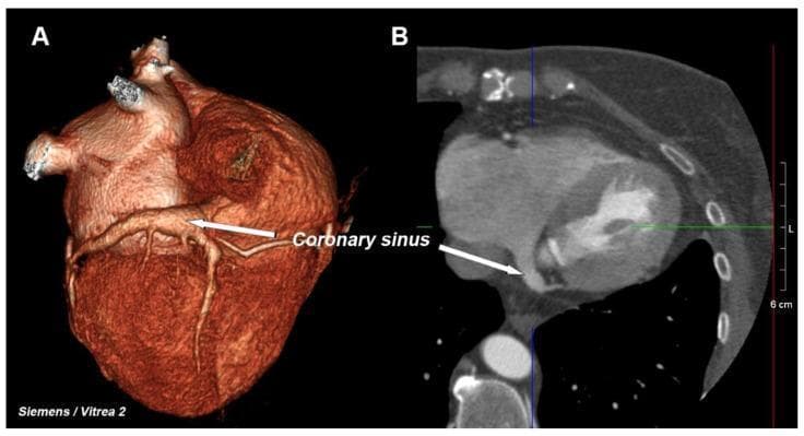 This dual-panel diagnostic image presents the cardiac anatomy focusing on the coronary venous system using Computed Tomography (CT). Panel A shows a 3D volume-rendered reconstruction of the heart, providing an external anatomical perspective. It highlights the surface morphology and the spatial orientation of the coronary sinus as it traverses the posterior atrioventricular groove. The rendering uses color and texture to differentiate vascular structures from the myocardial wall. Panel B displays a 2D multiplanar reformatted (MPR) reconstruction in an axial or oblique plane, offering a cross-sectional view of the internal cardiac chambers, including the right atrium and left ventricle. An arrow in both images identifies the coronary sinus, demonstrating its appearance both as a superficial vessel (3D) and as a distinct anatomical landmark within the thoracic cavity (2D). This comparison is clinically significant for electrophysiological procedures, such as cardiac resynchronization therapy (CRT) lead placement, where understanding the coronary sinus ostium and venous architecture is essential.