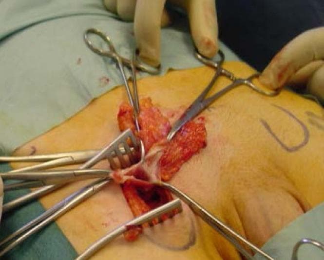 This clinical photograph captures an intraoperative view of a right femoral hernia repair using a low inguinal (Lockwood) approach. The surgical field displays a transverse skin incision in the groin area, with the underlying subcutaneous tissues and fascia dissected to reveal the femoral hernia sac. Retractors are positioned to provide exposure, while surgical clamps and forceps are utilized to manipulate the tissues. A prominent preperitoneal fat pad is visible, appearing as a yellowish, lobulated mass associated with the hernia sac. The sac itself exhibits a thin, fibrous, and membranous texture. The surrounding tissues demonstrate typical surgical hyperemia. This image is an educational example of inguinal anatomy during hernia management, specifically highlighting the identification of the hernia sac and its contents before reduction and mesh placement.