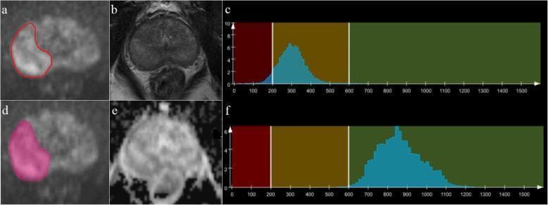 Multiparametric magnetic resonance imaging (mpMRI) and histogram analysis of the prostate in a 63-year-old male with benign prostatic hypertrophy (BPH). The panel includes axial views: (a, d) Diffusion-weighted imaging (DWI) at b=1500 s/mm2 showing an irregular lesion in the left peripheral zone delineated by red contour and pink segmentation mask; (b) T2-weighted (T2W) image providing detailed anatomical visualization of the prostate zonal anatomy and central gland enlargement; (e) Apparent Diffusion Coefficient (ADC) map showing corresponding restricted diffusion. Accompanying histograms (c, f) display quantitative signal intensity distributions for the T2W (c) and ADC (f) data, categorized into color-coded intensity zones (red, yellow, green). This composite demonstrates the workflow for whole-lesion texture and histogram analysis used to differentiate benign hypertrophy from prostatic carcinoma by evaluating parameters such as mean intensity, skewness, and kurtosis within the segmented volume of interest.