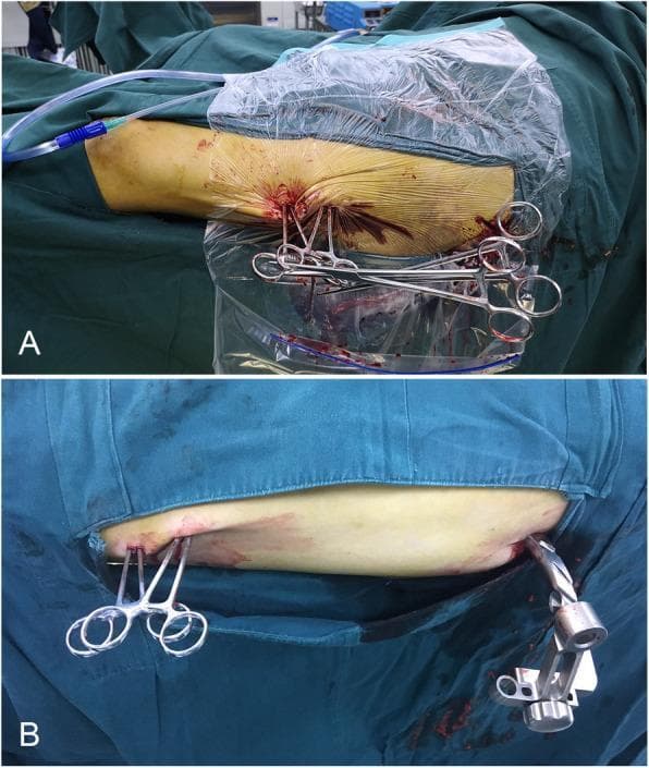 Two-panel clinical photograph illustrating a minimally invasive surgical technique for femoral shaft fracture reduction. Both panels show a patient's limb (thigh) in a sterile field with blue drapes and clear plastic adhesive drapes. In Panel A, two long, curved 26-cm haemostatic forceps are inserted into a percutaneous incision to act as levers for bone alignment. The forceps handles are interlocked to create a stable, self-maintaining structure, further secured by a Kocher forceps clamped across their shafts to prevent sliding. Blood and surgical tubing are visible at the operative site. Panel B demonstrates the same interlocking forceps technique in a separate patient case, showing the stable configuration of the two haemostatic forceps without the addition of a Kocher clamp. A second incision is visible distally, containing a larger orthopaedic instrument, likely related to intramedullary nail fixation. This visual sequence demonstrates the 'lever principle' using common surgical instruments to maintain fracture reduction percutaneously.