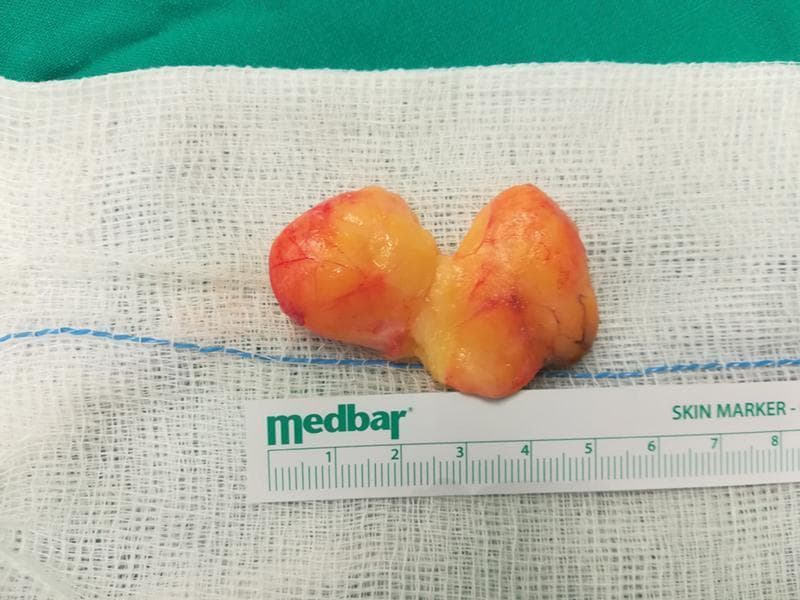 This clinical photograph shows a macro-anatomical specimen of an excised palmar lipoma. The tumor is bilobulated and demonstrates a characteristic adipose appearance, being primarily yellowish with a smooth, lobulated surface texture. Visible on the surface are fine reddish vascular markings and mild areas of hyperemia. The specimen is presented on a sterile white surgical gauze next to a metric skin marker ruler for scale, indicating that each lobe measures approximately 3 to 4 cm in length. This specific lipoma was dissected into two parts to preserve the recurrent motor branch of the median nerve during surgical treatment for carpal tunnel syndrome. The image illustrates the gross pathology of a deep palmar lipoma, a benign mesenchymal tumor, highlighting its size and morphological characteristics in the context of hand surgery and peripheral nerve decompression.