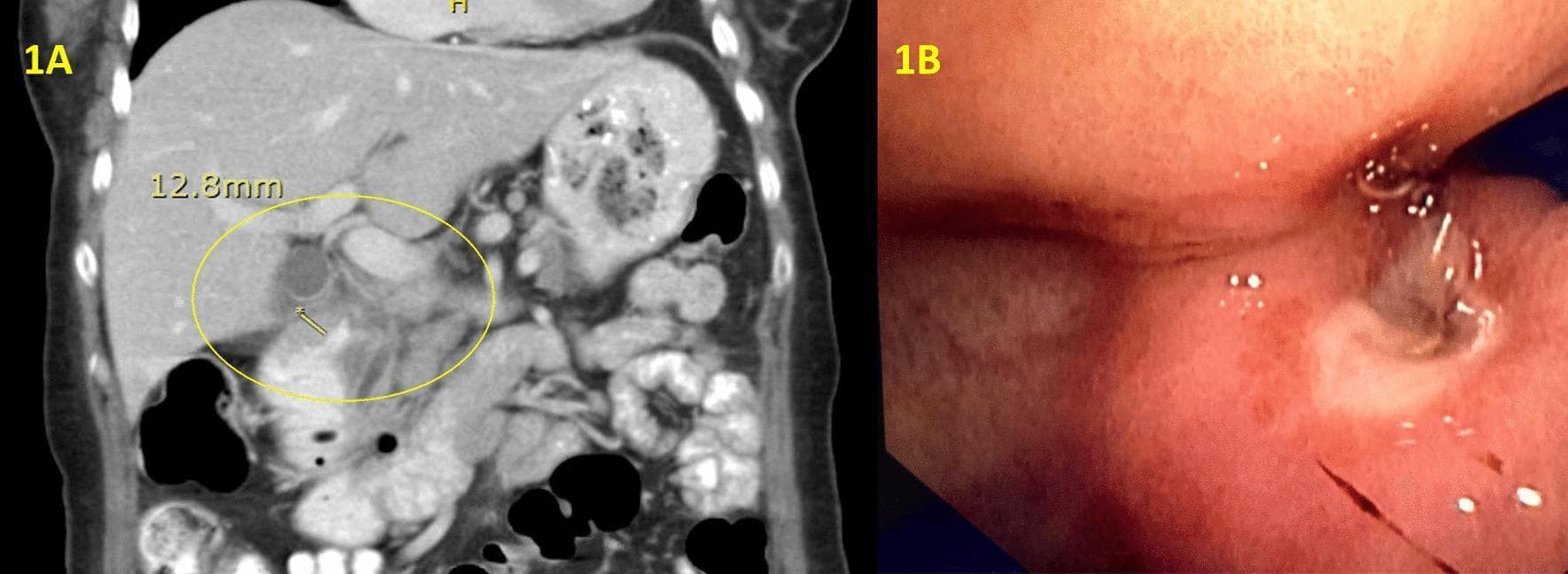 A composite medical image featuring diagnostic radiology and endoscopy of the upper gastrointestinal tract. Panel 1A is a coronal view from a contrast-enhanced computed tomography (CT) scan of the abdomen. It shows significant mural thickening of the proximal duodenum, highlighted by a yellow circle and annotated with a caliper measurement of 12.3mm. The surrounding anatomy, including the liver and right kidney, is visible. Panel 1B is an endoscopic photograph (gastroscopy) showing a clean-based antral ulcer extending into the duodenum. The image demonstrates a severe obstructing duodenal stricture, characterized by a narrow, distorted lumen and erythematous mucosal changes. These findings are clinically relevant for evaluating gastric outlet obstruction and differentiating between peptic ulcer disease and possible malignancy or IgG4-related disease in the proximal small bowel.