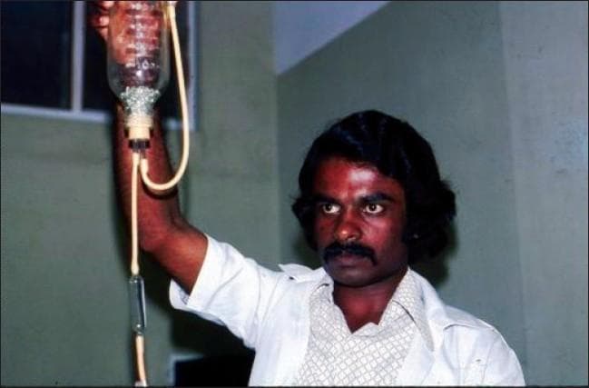 A clinical photograph of a historical blood transfusion setup from the early 1970s. The image displays a clear glass transfusion bottle held vertically by a medical professional. The interior of the bottle contains numerous small, round glass beads, which functioned as an early filtration system to trap clots or debris during the administration of blood products. Thick, translucent rubber tubing is connected to the base of the bottle, leading to an in-line vertical glass drip chamber. This chamber allowed for the visual monitoring of flow rates and the trapping of air bubbles before the blood reached the patient. The photograph illustrates the evolution of transfusion medicine and the transition from reusable glass and rubber equipment to modern, sterile, disposable plastic systems. This content is relevant for medical history, hematology, and the study of global health resource development in South Asia.