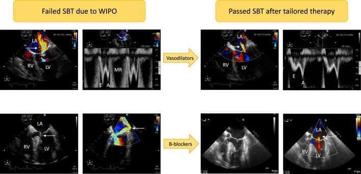 Transesophageal echocardiography (TEE) images demonstrating mechanisms of weaning-induced pulmonary edema (WIPO) and the response to targeted therapies. The top row illustrates a patient with hypertension during a failed spontaneous breathing trial (SBT). The color Doppler reveals acute, severe functional mitral regurgitation (MR) with a massive central jet and elevated transmitral Doppler E-wave velocities (1 m/s). Following intravenous vasodilator treatment, the follow-up panels show a significant reduction in the MR jet area and a decrease in E-wave velocity (0.5 m/s). The bottom row displays a second mechanism: dynamic left ventricular outflow tract (LVOT) obstruction caused by systolic anterior motion (SAM) of the mitral valve (white arrow). This results in a massive, eccentric MR jet. After beta-blocker administration, the follow-up images show complete resolution of the SAM-induced obstruction and only trivial residual MR. Key anatomical structures labeled include the left atrium (LA), left ventricle (LV), and right ventricle (RV). This diagnostic comparison highlights how echocardiography guides personalized management of WIPO by differentiating between loading-condition-induced functional MR and adrenergic-driven dynamic obstruction.