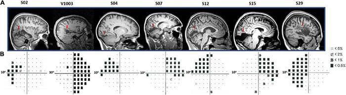 A composite figure correlating neuroanatomical lesions with functional visual field deficits in seven human subjects (labeled S02 through S29). Row A displays sagittal anatomical MRI brain scans for each subject. Red arrows indicate specific neuroanatomical lesions, including injuries to the primary visual cortex (V1), optic radiations, and temporoparietal regions, often resulting from historical ischemic or hemorrhagic strokes. Row B presents corresponding Humphrey perimetry test results (10-2 and 30-2 protocols) visualized as pattern deviation probability plots. These plots map visual field sensitivity across 10 to 30 degrees. Significant deficits, such as homonymous hemianopia and quadrantanopia, are indicated by dense clusters of black squares (probability p < 0.5%) and dotted squares (lower sensitivity). The visual data demonstrates the clinical correlation between focal cortical/subcortical brain damage and specific patterns of scotoma or visual field loss. This material is designed for advanced medical education in neurology, ophthalmology, and neuroimaging to illustrate the relationship between structural brain pathology and functional sensory impairment.
