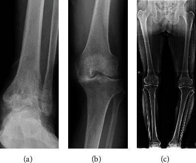 A composite image consisting of three anteroposterior (AP) radiographs demonstrating advanced multi-joint osteoarthritis and lower limb malalignment. Panel (a) shows an AP radiograph of the left ankle with Takakura stage 4 osteoarthritis, characterized by complete joint space loss between the tibia and talus, marginal osteophyte formation, and subchondral sclerosis. Panel (b) illustrates a left knee radiograph with Kellgren-Lawrence Grade IV changes, including severe medial compartment narrowing, osteophytes, and subchondral bone remodeling. Panel (c) is a preoperative standing weight-bearing AP radiograph of the bilateral lower extremities, showing a significant varus deformity of the left leg with a measured hip-knee-ankle (HKA) angle of 14.3 degrees. This series illustrates the clinical correlation between severe distal joint degeneration and global mechanical limb alignment issues in an orthopedic context.