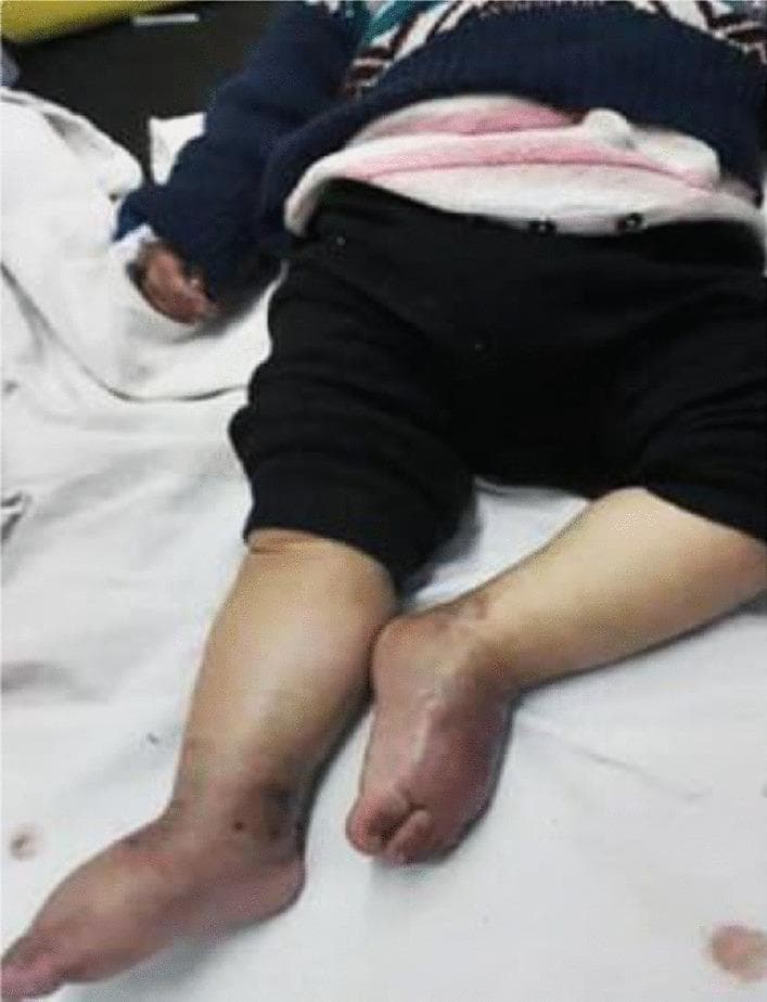 Clinical photograph of a pediatric patient (infant) demonstrating generalized pitting edema (Grade III) of the lower extremities. The photograph shows significant swelling of the bilateral legs and feet, with the skin appearing shiny, taut, and stretched. Distal skin discoloration is evident, particularly a reddish-purple hue on the dorsal surfaces of both feet. The left lower leg displays focal dark, hyperpigmented lesions near the ankle and lateral foot. These physical findings are associated with severe hypoalbuminemia (2.1 g/dl) and total protein deficiency, clinically linked to a protein-losing enteropathy in the context of ulcerative colitis. The image serves as an educational example of how systemic inflammatory bowel disease in infants can manifest with severe malnutrition and edema due to oncotic pressure changes.