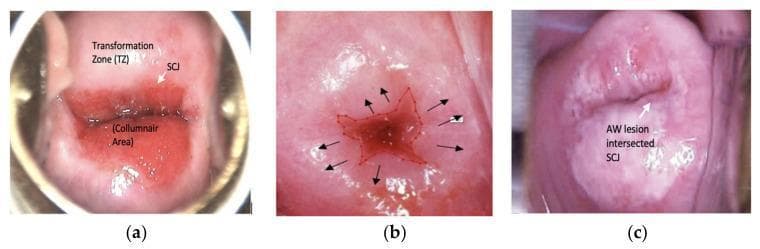 This set of clinical photographs depicts cervical anatomy and pathology as seen during colposcopy or cervicography after the application of acetic acid. Image (a) illustrates normal cervical landmarks, identifying the central red columnar area (CA) consisting of a single layer of columnar epithelium, the surrounding pink transformation zone (TZ) composed of stratified squamous epithelium, and the squamocolumnar junction (SCJ) representing the border between these two regions. Image (b) shows the progression of squamous metaplasia at the squamocolumnar junction. Image (c) demonstrates an abnormal clinical finding: an acetowhite (AW) lesion. This white, opaque area arises from the SCJ and extends into the transformation zone, a visual manifestation characteristic of cervical intraepithelial neoplasia (CIN) or precancerous lesions. The images serve as educational tools for identifying key anatomical structures and differentiating normal physiological changes from pathological acetowhite reactions during cervical cancer screening and visual inspection with acetic acid (VIA).