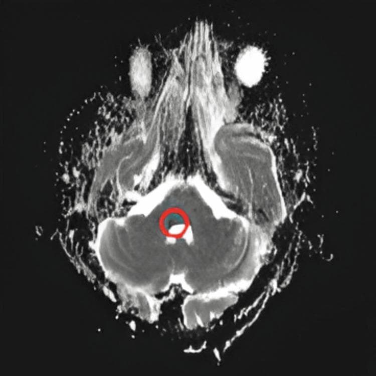 This diagnostic image is an axial Apparent Diffusion Coefficient (ADC) map from a brain Magnetic Resonance Imaging (MRI) study. The image shows the posterior fossa at the level of the brainstem and cerebellum. A red circle highlights a focal area of decreased signal intensity (hypointensity) within the brainstem. This hypointense signal on an ADC map, when correlated with hyperintensity on diffusion-weighted imaging (DWI), confirms true diffusion restriction, which is a hallmark finding of acute ischemic stroke (infarction). The surrounding cerebellar tissue displays intermediate signal intensity, while the fourth ventricle is visible as a high-signal (bright) area posterior to the brainstem. This image is used in clinical neurology and radiology to differentiate acute cerebral infarction from other pathologies by confirming cytotoxic edema.