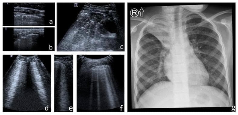 A collation of clinical images comparing lung ultrasound (LUS) and chest X-ray (CXR) findings in the context of cystic fibrosis. Panels (a) and (b) demonstrate pleural line abnormalities, including irregularity and fragmentation. Panel (c) shows a large subpleural consolidation with heterogeneous echogenicity and static air bronchograms. Panels (d), (e), and (f) highlight characteristic LUS artifacts: (d) illustrates Am-lines (broad vertical artifacts containing parallel horizontal lines), (e) shows a single confluent B-line, and (f) displays multiple discrete B-lines (comet-tail artifacts) arising from the pleural line. Panel (g) is a posterior-anterior chest X-ray showing advanced pulmonary changes including a barrel chest deformity, hyperinflation (increased transparency) of the left upper and middle lobes, and right upper lobe opacity consistent with cirrhosis and atelectasis. Evidence of bilateral bronchiectasis is present, characterized by peribronchial thickening and tram-track signs. These images represent a diagnostic comparison between LUS scoring and traditional radiographic assessment (modified Chrispin–Norman score) for monitoring chronic lung disease progression.