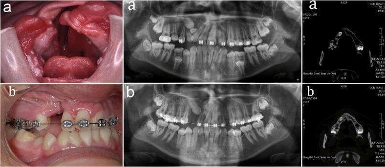 This composite figure illustrates the clinical and radiographic management of a cleft lip and palate through alveolar bone grafting. Row (a) displays the preoperative state: the clinical photograph reveals a significant oronasal communication with irregular, erythematous soft tissue margins; the panoramic radiograph and axial CT scan show a distinct osseous defect in the maxillary alveolar ridge with dental malalignment. Row (b) demonstrates the postoperative results: the clinical image shows a partially closed alveolar cleft with orthodontic appliances in place for dental alignment; the corresponding panoramic radiograph and CT scan reveal increased radiopacity in the previously cleft region, indicating successful integration of the bone graft and restoration of the maxillary arch continuity. The images serve as an educational comparison of secondary alveolar bone grafting outcomes in pediatric maxillofacial surgery, highlighting the transition from a structural defect to an integrated osseous bridge suitable for tooth eruption or implant placement.