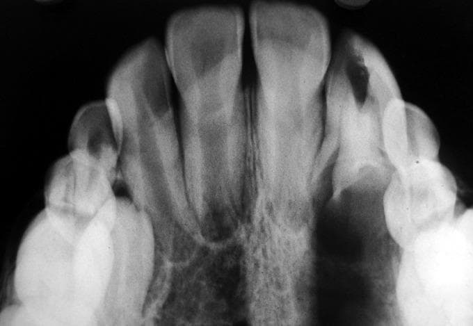 This diagnostic image is an occlusal radiograph showing the maxillary or mandibular anterior dentition. The central and lateral incisors are prominently visible as radiopaque structures, with their respective pulp chambers and root canals discernible. A notable finding is a well-defined area of radiolucency in the crown of a lateral incisor, characteristic of dental caries or a pathological lesion. The surrounding alveolar bone demonstrates typical trabecular patterns with varying radiopacity. The periodontal ligament space is visible as a thin, continuous radiolucent line encompassing the roots, and the lamina dura appears as a thin radiopaque border. The radiograph illustrates key dental anatomy, including the relationship between crown density, root morphology, and supporting periodontal structures, making it an essential educational resource for studying dental pathology and intraoral imaging techniques.