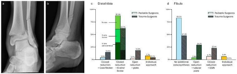 Educational material regarding pediatric trauma management, featuring diagnostic imaging and treatment preference data. (a) Anterior-posterior and (b) lateral X-ray views of a 15-year-old male demonstrate a displaced Salter-Harris Type 2 fracture of the distal tibia and a concomitant distal fibula shaft fracture. The growth plate is clearly visible, signifying skeletal immaturity. The distal tibia fracture shows a characteristic metaphyseal 'Thurston Holland' fragment and transverse extension through the physis. Graphs (c) and (d) provide a comparison of surgical preferences between pediatric surgeons and trauma surgeons for managing these specific injuries. For the distal tibia (c), pediatric surgeons favored closed reduction with percutaneous or buried K-wires, while trauma surgeons showed a higher preference for open reduction and internal fixation with plates. For the fibula (d), pediatric surgeons predominantly opted for no additional osteosynthesis, whereas trauma surgeons more frequently recommended open reduction with tubular plates or closed reduction with Elastic Stable Intramedullary Nailing (ESIN). The content illustrates the clinical intersection of pediatric orthopedics and general trauma surgery.