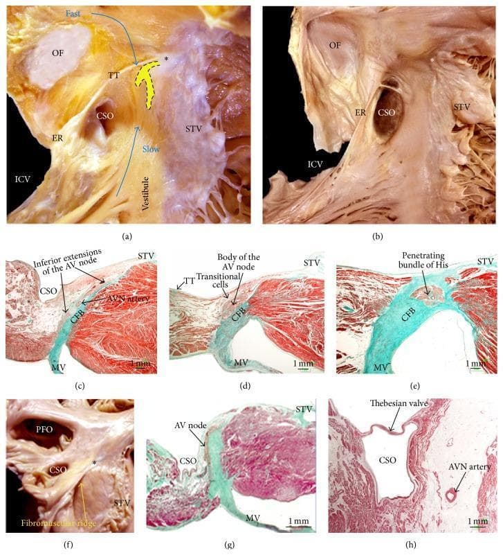 This composite figure illustrates the cardiac anatomy of the right atrium, specifically focusing on the triangle of Koch and the atrioventricular (AV) conduction system through gross dissections and histological sections. (a, b) Gross dissections of the right atrium in a right anterior oblique view show the anatomical borders of the triangle of Koch: the tendon of Todaro (TT) posteriorly, the hinge of the septal leaflet of the tricuspid valve (STV) anteriorly, and the coronary sinus ostium (CSO) inferiorly. Annotations highlight the putative fast and slow electrical pathways. (c, d, e) Histological sections (Masson's trichrome stain) demonstrate the transition from the inferior extensions of the AV node to the compact AV node body and the penetrating bundle of His through the central fibrous body (CFB). (f, g) Specimens showing Ebstein's anomaly, characterized by a smaller triangle of Koch and a displaced AV node. (h) Sagittal section showing the proximity of the AV nodal artery to the endocardium near the CSO. Other visible landmarks include the oval fossa (OF), inferior vena cava (ICV), and Eustachian ridge (ER).