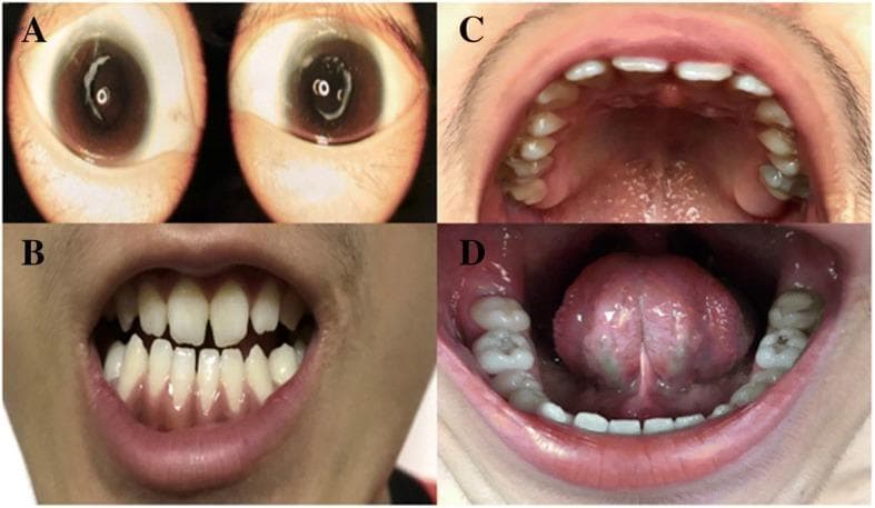 This composite clinical photograph displays the primary phenotypic manifestations of Nance-Horan syndrome (NHS) in a 15-year-old male. Panel A consists of slit-lamp photographs demonstrating bilateral congenital nuclear cataracts, characterized by central lens opacification. Panels B, C, and D show oral clinical findings. Panel B highlights screwdriver-shaped (tapered) permanent incisors with narrowed incisal edges. Panel C identifies a missing maxillary second molar and dental crowding. Panel D illustrates mulberry-like molars featuring irregular occlusal surfaces and multiple small cusps. Collectively, these images illustrate the diagnostic triad of ocular, dental, and craniofacial anomalies associated with NHS, a rare X-linked disorder. The presentation is essential for clinical genetics and pediatric ophthalmology/dentistry education, emphasizing the multisystem nature of congenital cataract syndromes.