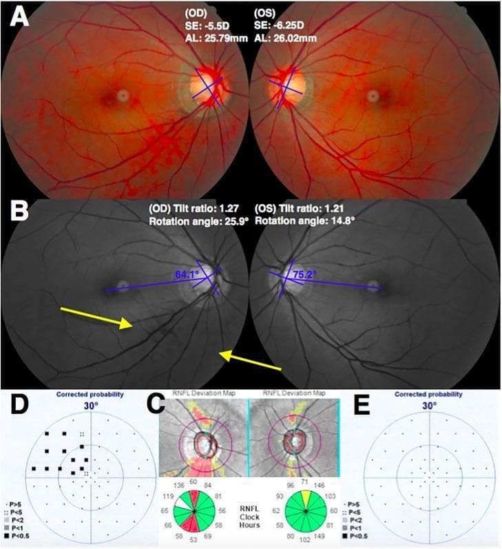 This composite ophthalmological image illustrates a comparative glaucoma case study focusing on the relationship between optic disc morphology and visual field (VF) loss in a myopic patient. (A) Color fundus photographs of the right (OD) and left (OS) eyes display bilateral optic disc tilting and peripapillary atrophy (PPA). (B) Red-free fundus images annotate disc tilt ratios and rotation angles, highlighting a more pronounced inferior rotation (25.9°) in the less myopic right eye. Yellow arrows indicate an inferotemporal retinal nerve fiber layer (RNFL) defect in the right eye. (C) SD-OCT RNFL deviation maps and clock-hour diagrams show significant inferotemporal thinning (indicated by red and yellow coding) in the right eye compared to the relatively normal thickness profile of the left eye. (D, E) Standard automated perimetry (Humphrey Visual Field) results show a corresponding superior nasal step defect in the right eye (D), while the left eye (E) remains largely within normal limits. The image demonstrates that in myopic glaucoma, greater optic disc rotation may correlate more strongly with glaucomatous damage than the absolute degree of axial myopia.