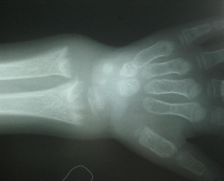 This diagnostic radiograph displays the wrist and hand of a pediatric patient, highlighting characteristic skeletal features of rickets. The imaging modality is conventional X-ray. The distal metaphyses of the radius and ulna exhibit significant pathological changes, including transverse widening (flaring), distinctive concave incurvation known as 'cupping,' and irregular, frayed margins referred to as 'fraying.' There is a visible increase in the radiolucent space between the metaphysis and the epiphysis, indicating growth plate widening. Additionally, the radiograph demonstrates generalized osteopenia or diffuse demineralization, characterized by thinned cortical bone and reduced trabecular density throughout the visualized long bones and metacarpals. These findings are clinically significant for vitamin D deficiency or other metabolic bone diseases affecting mineralized cartilage. This material is suitable for intermediate medical education focusing on pediatric orthopedics or endocrinology.