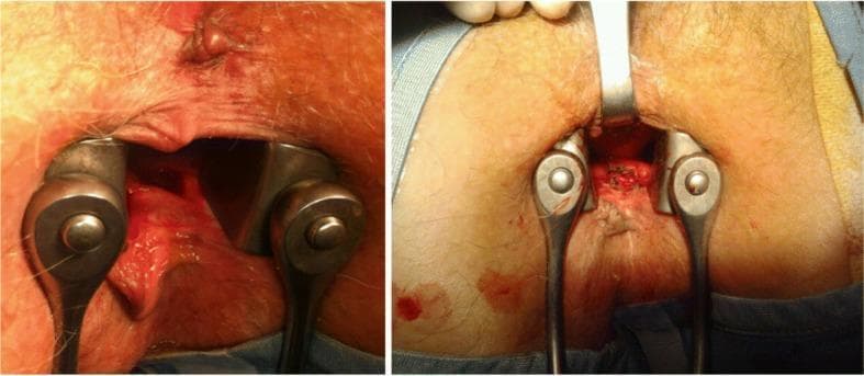 Two clinical photographs demonstrate the surgical management of a perianal abscess. The left image provides an intraoperative view of the anal verge and canal, stabilized with metal anal retractors. A deep, erythematous recess approximately 2-3 cm in diameter is visible on the right posterior-lateral anal wall, exhibiting signs of acute inflammation and tissue breakdown consistent with an infected abscess. The right image shows the post-operative state after surgical intervention. The procedure involved opening and deroofing the abscess cavity followed by curettage of the fundus. The surgical site appears as an open, raw-surfaced wound with irregular margins, facilitating drainage and secondary intention healing. The surrounding perianal skin remains erythematous, and surgical instruments remain in place to visualize the debrided cavity. This educational visual illustrates the fundamental surgical technique for treating deep-seated perianal infections that are non-responsive to conservative antibiotic management.