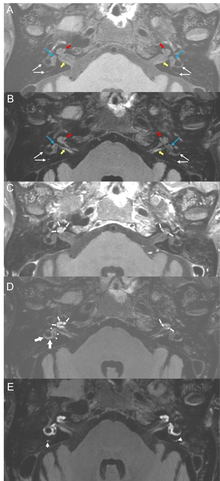 This diagnostic imaging sequence presents a series of axial Magnetic Resonance Imaging (MRI) scans of the internal auditory canal (IAC), comparing pre-contrast and post-contrast enhancement patterns in the inner ear. (A) Pre-contrast T1-weighted and (B) 3D Fluid-Attenuated Inversion Recovery (FLAIR) images establish baseline normal signal intensity in the bilateral cochlea, vestibules, and semicircular canals. (C) Post-contrast T1-weighted and (D) 10-minute delayed 3D FLAIR images show initial enhancement of the bilateral cochlea and subtle uptake in the right vestibule. (E) 4-hour delayed 3D FLAIR image demonstrates profuse, widespread hyperintense signal across the bilateral cochlea, vestibules, and lateral and posterior semicircular canals. This progressive contrast accumulation over time indicates a breakdown of the blood-labyrinth barrier (BLB). The image illustrates a key neuroradiological protocol for assessing inner ear inflammatory conditions, labyrinthitis, or endolymphatic hydrops, highlighting the clinical utility of delayed post-contrast FLAIR sequences in detecting subtle barrier permeability changes.