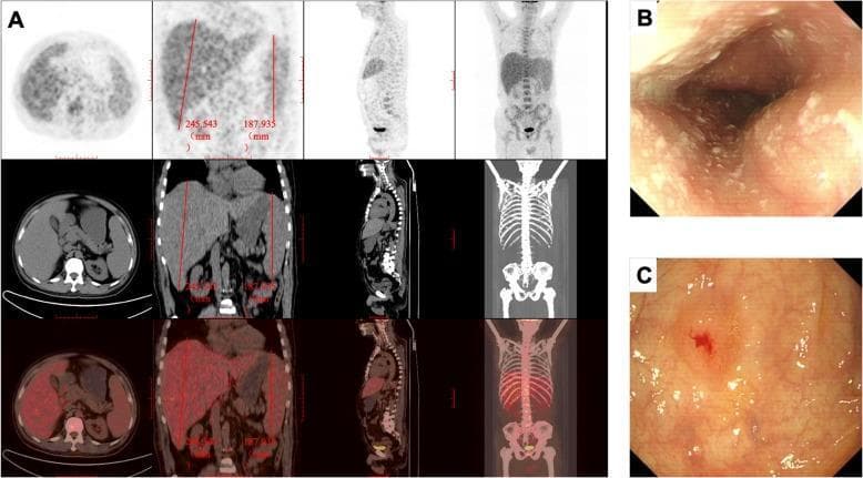 A multi-modal clinical imaging panel demonstrating systemic involvement of a fungal infection, likely Histoplasmosis. (A) Composite 18F-FDG PET/CT images in axial, coronal, sagittal, and maximum intensity projection (MIP) views. The images reveal significant hepatosplenomegaly (liver length 245.5 mm, spleen length 187.9 mm) with increased metabolic activity. There is also evidence of diffuse hyper-metabolism in the bone marrow and abdominal lymphadenopathy. (B) Upper gastrointestinal endoscopy image of the esophagus showing white, bean-curd-like plaques covering the mucosal surface, characteristic of fungal esophagitis (e.g., Candida). (C) Lower gastrointestinal endoscopy image of the colon depicting a protuberant, umbilicated lesion with central depression, erosion, and surrounding erythema, indicative of granulomatous mucosal inflammation from mycotic infection. The combination of findings illustrates systemic disseminated disease with multi-organ involvement including the reticuloendothelial system and gastrointestinal tract.
