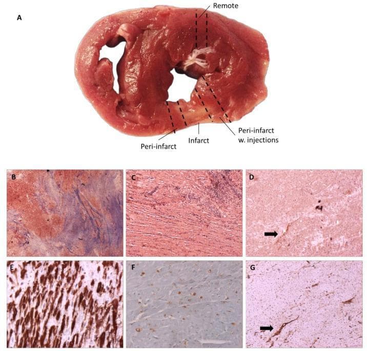 This composite educational image illustrates myocardial histology following infarction. Panel A displays a gross clinical photograph of a transverse heart section (minipig model), with dashed lines demarcating 'Remote', 'Infarct', and 'Peri-infarct' sampling regions. Panels B and C show light microscopy of the infarcted tissue; Masson’s Trichrome (B) reveals significant collagen deposition (blue staining), indicating fibrosis, while Hematoxylin-eosin (C) demonstrates myocyte arrangement and cellular infiltration. Panels D through G utilize immunohistochemistry (IHC) to identify molecular markers in the peri-infarct and infarct areas. Integrin αvβ3 (D) and CD31 (G) staining (light brown) highlight neo-angiogenesis and endothelial structures, with arrows indicating co-localized vascular expression. Alpha-smooth muscle actin (E) shows dense brown staining of myofibroblasts within the scar tissue. CD68 (F) displays punctate brown staining consistent with macrophage infiltration. This visual material is used to teach concepts related to tissue remodeling, fibrotic scar formation, and the inflammatory response in ischemic heart disease.