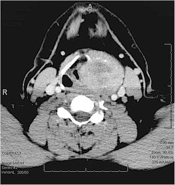 Axial contrast-enhanced CT scan of the neck at the level of the larynx. The image demonstrates a large, heterogeneously enhancing mass measuring approximately 5 x 5.7 cm, centered in the left laryngeal region. Key findings include the complete destruction of the left thyroid cartilage and medial extension of the tumor, which significantly compresses the laryngeal ventricle and narrows the airway at the level of the vocal cords. The mass exhibits central areas of decreased attenuation (suggestive of necrosis or cystic components) and early punctate calcifications. Disruption of normal anatomy is evident through the lateral displacement and compression of the left carotid sheath and sternocleidomastoid muscle. The lesion extends superiorly toward the hyoid bone, obliterating the left pyriform sinus. This diagnostic image illustrates the local invasiveness typical of primary laryngeal bone or cartilage tumors, such as chondrosarcoma or giant cell tumor of the larynx.