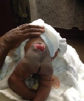 This clinical photograph shows a neonate in a prone position, demonstrating a prominent neural tube defect in the lumbar spine. The lesion is consistent with spina bifida cystica (myelomeningocele). There is a visible midline protrusion with an open, erythematous neural plaque (placode) where the spinal cord and meningeal tissues are exposed through a defect in the skin and vertebral arches. The surrounding skin appears thin at the margins of the sac. The lower extremities are visible, appearing somewhat flaccid with internal rotation of the thighs, which is clinically significant for potential neurological impairment associated with the spinal lesion. The image is a primary resource for medical education regarding congenital central nervous system malformations and neonatal physical examination findings.