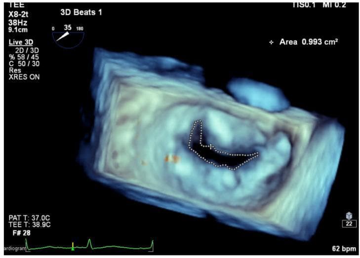 This diagnostic image demonstrates the quantification of the Mitral Valve Area (MVA) using three-dimensional transesophageal echocardiography (3D TEE) planimetry. The central 3D volumetric rendering displays a cropped 'en face' view of the mitral valve apparatus. An irregularly shaped, dark central orifice representing the mitral opening is manually traced with a dotted white line for planimetric measurement. The clinical significance of this procedure is to assess the severity of mitral stenosis, particularly in cases of degenerative calcification where 2D imaging may be less accurate. The top right of the display indicates a calculated MVA of 0.993 cm². Technical parameters on the left show the use of an X8-2t transducer, a frequency of 38Hz, and a depth of 9.1cm in 'Live 3D' mode. An electrocardiogram (ECG) trace at the bottom indicates the measurement timing within the cardiac cycle at a heart rate of 62 bpm. This image is a key educational example of advanced cardiac imaging used for structural heart disease assessment and intervention planning.