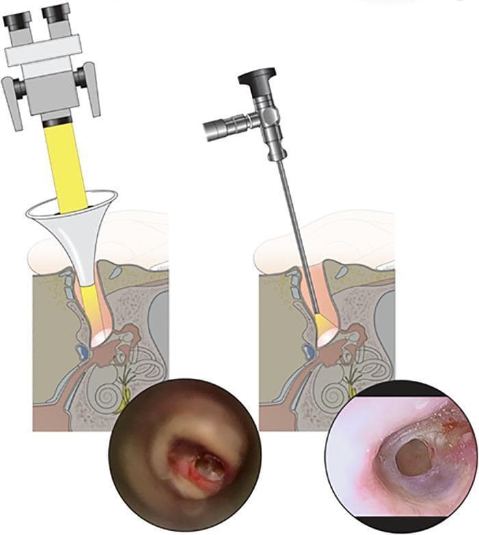 A comparison of microscopic versus endoscopic transmeatal approaches for visualizing the tympanic membrane. The left side features a diagram of an operating microscope directing a wide beam of light through an ear speculum, paired with a microscopic otoscopic photograph. The photograph shows a subtotal tympanic membrane perforation with restricted visualization of the anterior margins due to the linear line-of-sight constraints of the microscope. The right side displays a diagram of a rigid endoscope inserted deep into the external auditory canal, paired with a wide-angle endoscopic photograph. This view provides superior clarity and a comprehensive, circular perspective of the perforation edges, including the anterior-inferior quadrant. This educational visual demonstrates the clinical advantages of endoscopic ear surgery (EES) in achieving a wider field of view and enhanced detail of middle ear structures compared to traditional microscopic techniques.