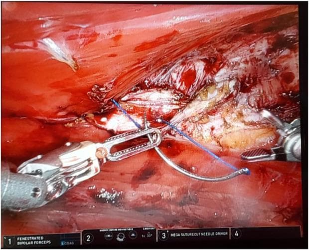 This clinical photograph displays a high-definition intraoperative view of a robotic-assisted surgical procedure, specifically an extended totally extraperitoneal (eTEP) repair for paraumbilical hernia and rectus diastasis. The visual focus is on the apposition of the rectus muscles within the retro-rectus space. The surgical field reveals deep red striated muscle tissue and white-to-translucent connective fascia. Central to the image is the active use of robotic endo-wristed instrumentation: a set of fenestrated bipolar forceps on the left and a mega suturecut needle driver on the right. The needle driver is shown manipulating a curved surgical needle threaded with a blue monofilament suture, demonstrating intracorporeal suturing technique. This image serves as an educational example of robotic hernia repair, highlighting the precision of robotic tools in reconstructing the abdominal wall by bringing the medial edges of the rectus muscles together.