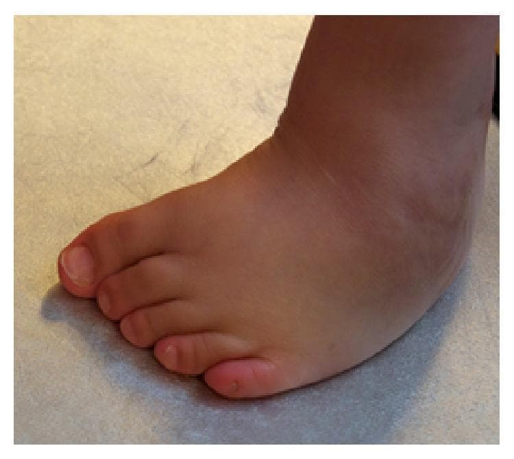 Clinical photograph of a human foot, anterior-oblique view, demonstrating a recurrent congenital talipes equinovarus (clubfoot) deformity following previous surgical revision. The image illustrates the 'CAVE' mnemonic components typical of residual clubfoot: cavus (high midfoot arch), forefoot adduction (inward deviation of the toes), and hindfoot varus (inward rotation of the heel). Soft tissue examination reveals significant swelling localized around the ankle joint and across the dorsal surface of the foot. Distal changes include callus formation on the plantar-lateral aspect and the tip of the first digit, indicating pathological weight-bearing and altered biomechanics. This visual serves as an educational example of incomplete surgical correction or disease recurrence in pediatric orthopedics, specifically within the context of Möbius syndrome management.