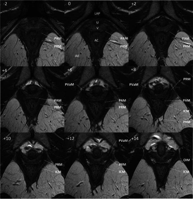 This diagnostic image consists of a series of nine axial T2-weighted MRI scans showing the female pelvic floor anatomy in a healthy 28-year-old subject. The scans are organized sequentially from -2 mm (caudal) to +14 mm (cranial) relative to the arcuate pubic ligament (LAP, plane 0). Key pelvic structures identified include the urethra (U), vagina (V), and anal canal (AC). The series focuses on the subdivisions of the levator ani muscle group. In the distal planes (-2 to +4), the puboanal muscle (PAM) and puborectal muscle (PRM) are clearly visible, with the PAM located medially to the PRM. As the sections move cranially (+6 to +14), additional muscular structures appear, including the pubovaginal muscle (PVaM), the iliococcygeal muscle (ICM), and the most lateral obturator internus muscle (OIM). The ischioanal fossa (IAF) is visible as a high-signal (bright) fatty area. This sequence illustrates the normal spatial relationships and origins of the pelvic floor musculature, serving as a reference for assessing pelvic organ prolapse or muscle trauma.