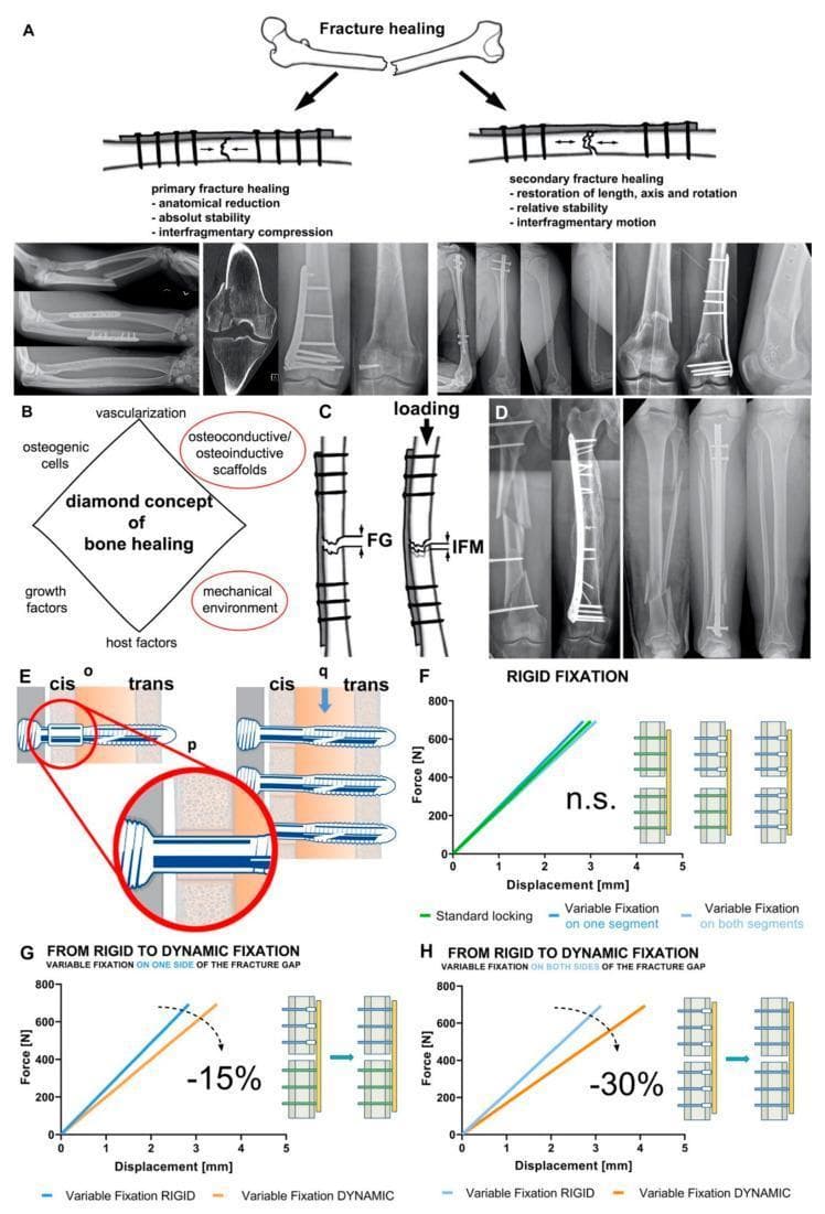 This composite educational image illustrates the mechanobiology of bone fracture healing and orthopedic fixation technologies. Section A compares primary healing (absolute stability, direct contact via compression plates/lag screws, no callus) with secondary healing (relative stability, interfragmentary motion via intramedullary nails/bridge plates, visible callus). Section B details the 'Diamond Concept' of healing, including osteogenic cells, scaffolds, growth factors, and the mechanical environment. Section C defines interfragmentary strain as the ratio of interfragmentary movement (IFM) to fracture gap (FG). Section D shows clinical radiographs of rigid versus flexible fixation in femoral and tibial shaft fractures. Sections E–H focus on Variable Fixation Locking Screw (VFLS) technology. A diagram (E) demonstrates a screw (q) within a resorbable sleeve (p) passing through the cis-cortex and trans-cortex (o). Biomechanical graphs (F, G, H) illustrate construct stiffness transitions, showing that sleeve resorption decreases stiffness by 15% to 30% depending on the configuration, thereby dynamizing the fracture site to stimulate healing.