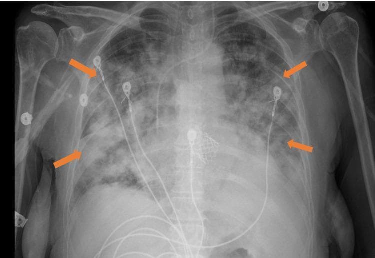 This anteroposterior (AP) chest X-ray illustrates bilateral, diffuse alveolar airspace opacities throughout both lung fields (indicated by orange arrows). The opacities present as patchy, confluent infiltrates characteristic of acute pulmonary edema or transfusion-related acute lung injury (TRALI). The distribution is relatively uniform across the lung parenchyma, obscuring underlying vascular markings. Several medical devices are visible: multiple ECG leads, a central venous catheter entering from the right, and a radiopaque cardiac device in the midline mediastinum, likely representing a transcatheter aortic valve replacement (TAVR) prosthesis. The cardiac silhouette is obscured by the overlying pulmonary infiltrates. This diagnostic image is used to teach radiographic recognition of acute respiratory distress syndrome (ARDS) or acute pulmonary congestion following medical intervention such as fluid resuscitation or transfusion.