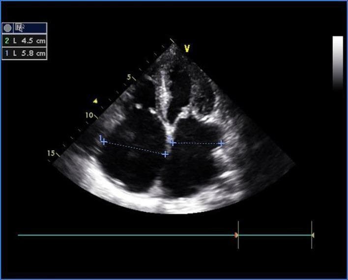 This diagnostic image is a transthoracic echocardiogram (TTE) in the apical four-chamber view, providing a simultaneous visualization of both the left and right sides of the heart. The ultrasound displays significant structural pathology of the atrioventricular valves. The mitral valve leaflets appear diffusely thickened and exhibit a characteristic 'doming' appearance during diastole, classic for rheumatic mitral stenosis. Similarly, the tricuspid valve leaflets demonstrate matching morphological changes, including thickening and diastolic doming, indicative of concurrent tricuspid stenosis. Measurement calipers (labeled 1 and 2) are visible across the dilated atria, with values of 5.8 cm and 4.5 cm recorded in the upper left corner. The image illustrates multi-valvular rheumatic heart disease involving both the left-sided and right-sided chambers, resulting in atrial enlargement secondary to obstructive valvular pathology. This image is an essential educational tool for identifying the echocardiographic hallmarks of chronic rheumatic valvulitis and assessing cardiac chamber dimensions in the setting of severe stenosis.
