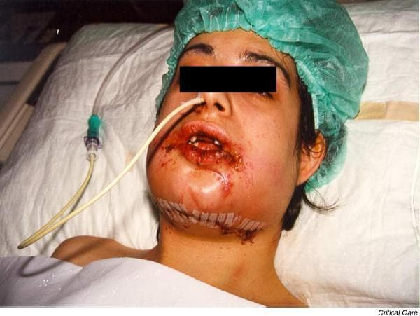 This clinical photograph shows a patient in a supine position following major maxillofacial trauma and surgery. The patient exhibits significant postoperative or post-traumatic facial edema, particularly concentrated in the perioral and submental regions. Visible signs include hemorrhagic crusting and lacerations around the lips and oral mucosa. A pediatric airway exchange catheter (PAEC) is inserted nasally through the right nostril, secured as a bridge for potential reintubation. The oral cavity demonstrates inter-maxillary fixation (archbars), which limits mouth opening. Surgical adhesive strips (Steri-Strips) are applied along the submental and mandibular lines to support surgical incisions or wound closure. The patient is wearing a green surgical cap. This image illustrates the management of a difficult airway in the Intensive Care Unit (ICU) setting, specifically highlighting the use of airway exchange catheters in patients with restricted jaw mobility due to surgical fixation for facial fractures.