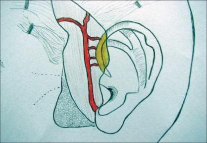 This medical anatomical diagram illustrates the surgical vascular anatomy for a vascularized auricular cartilage flap. The illustration shows a profile view of the human ear and the preauricular region. The superficial temporal artery (STA) is highlighted in red, coursing vertically in the preauricular plane. Several horizontal arterial branches are shown originating from the STA and extending toward the root of the helix. A specific yellow-shaded region identifies a cartilage flap being harvested from the helical root, demonstrating its relationship to the supplying vascular pedicle. Key anatomical structures depicted include the helix, antihelix, tragus, and concha. The diagram serves as a surgical planning aid for reconstructive procedures, such as temporomandibular joint (TMJ) ankylosis surgery, where vascularized cartilage is used for interpositional arthroplasty. It highlights the importance of preserving the delicate arterial supply from the STA to the helical cartilage to ensure flap viability.
